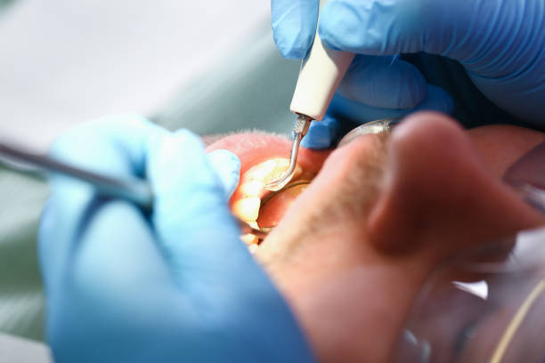 Best Emergency Treatment for Dental Infections or Abscesses in Schuylerville, NY