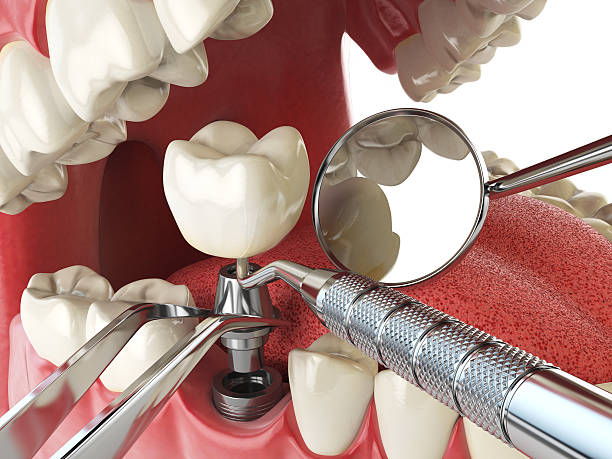 Best Emergency Dental Care for Broken or Chipped Teeth in Schuylerville, NY